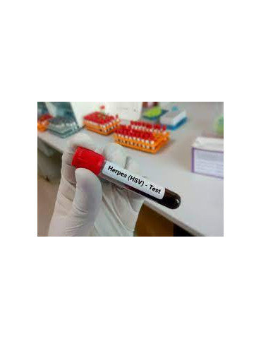 HERPES SIMPLEX VIRUS (HSV)-IgM (THY)