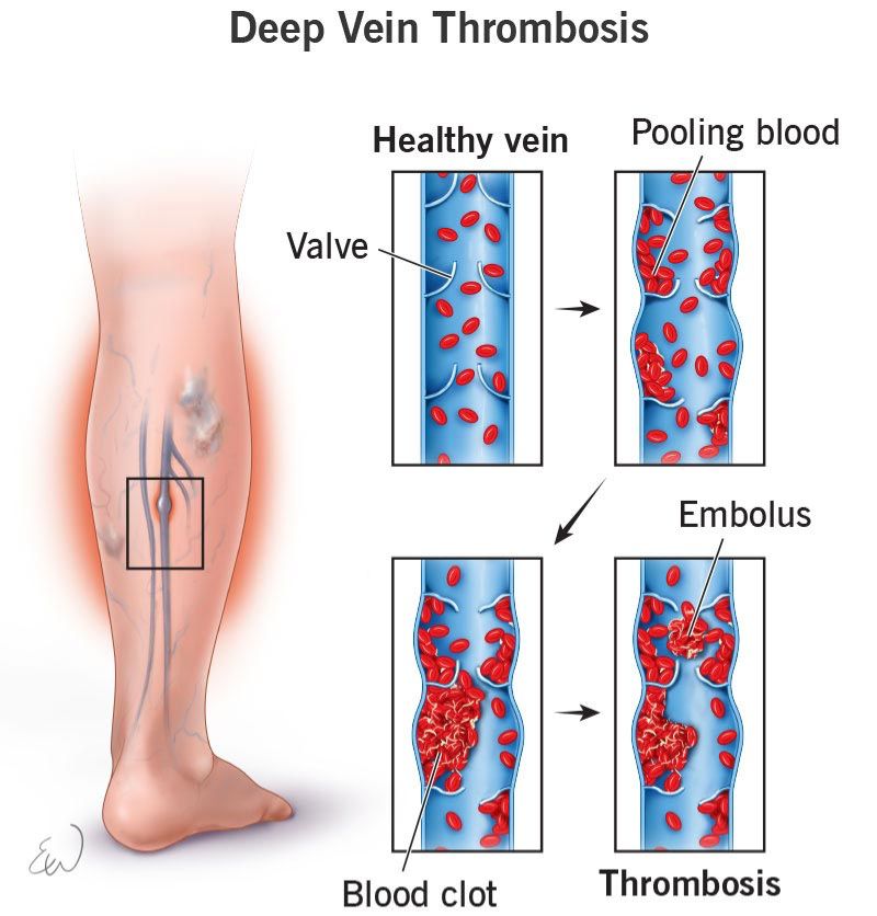 Deep Vein Thrombosis (DVT)