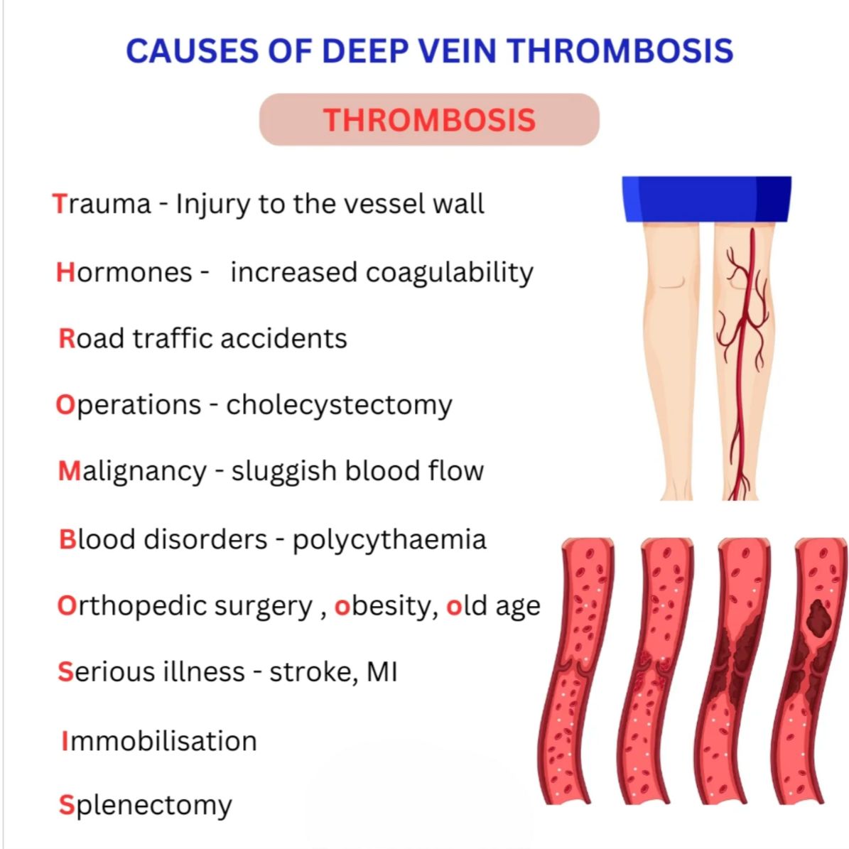 Causes of DVT