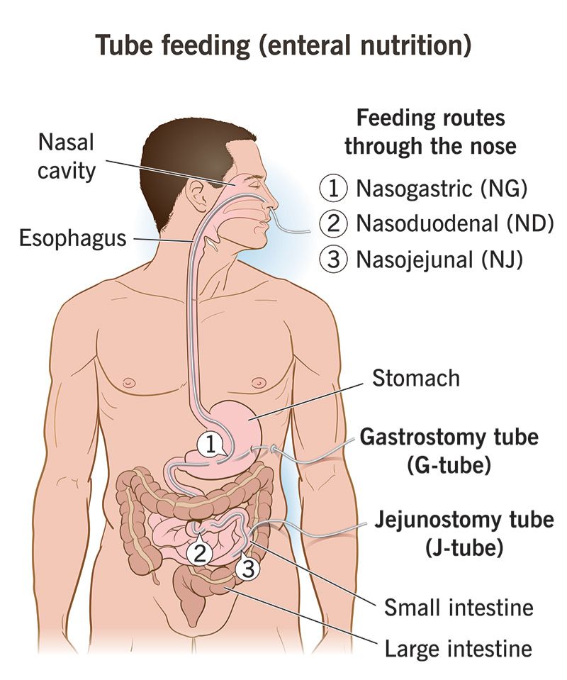 Tube Feeding Types